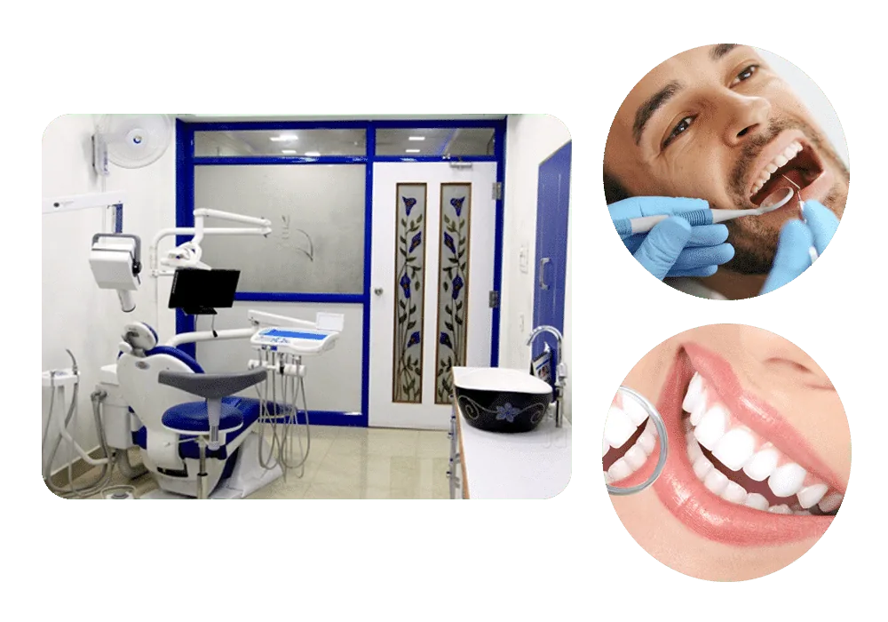Dental Veneers in Madurai - Dentes Clinic