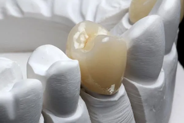 Dental Veneers in Madurai - Dentes Clinic