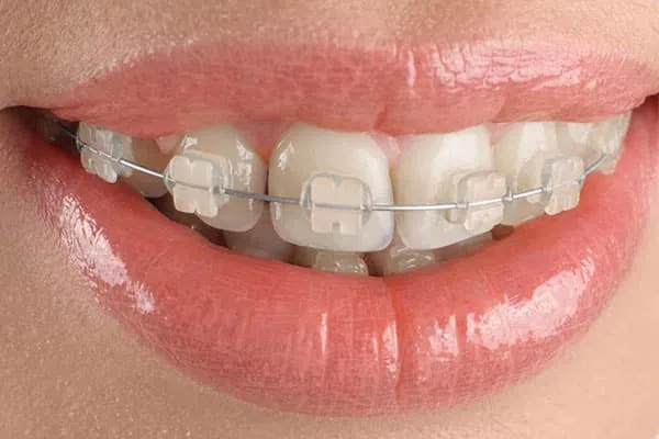 Best Invisalign Treatment in Madurai - Dentes Clinic