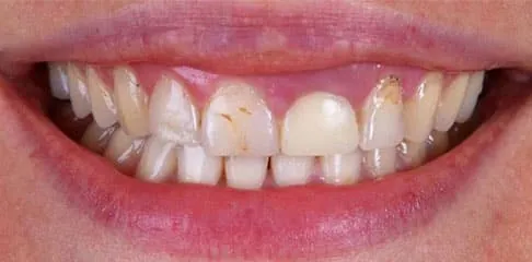 Teeth Whitening in Madurai - Dentes Clinic