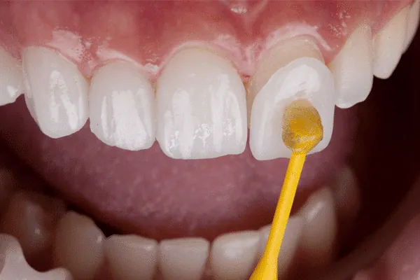Clear removable aligners for teeth straightening