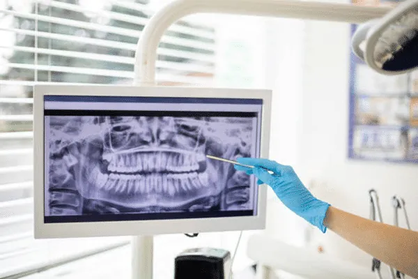 Flexible Dentures in Madurai - Dentes Clinic