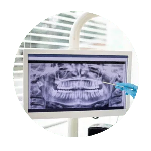 Digital Smile Design in Madurai - Dentes Clinic