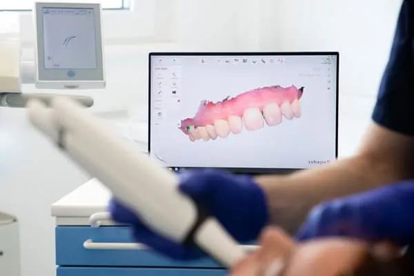 Dental Crowns in Madurai - Dentes Clinic