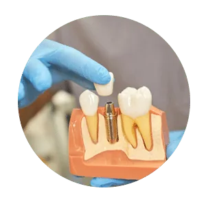 Dentures in Madurai - Dentes Clinic