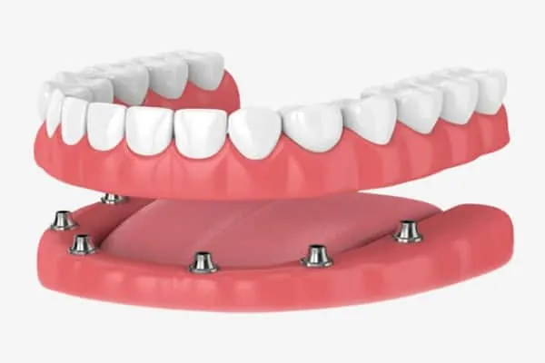 Dental Implants in Madurai - Dentes Clinic