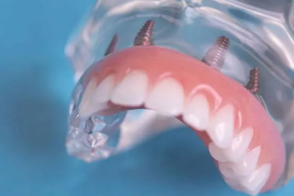 Clear Braces in Madurai - Dentes Clinic