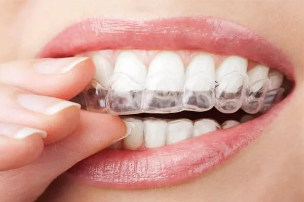 Dental Implants in Madurai - Dentes Clinic