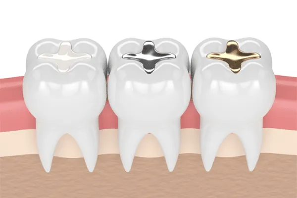 Denture Implants in Madurai - Dentes Clinic