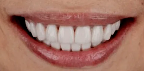 Best Invisalign Treatment in Madurai - Dentes Clinic
