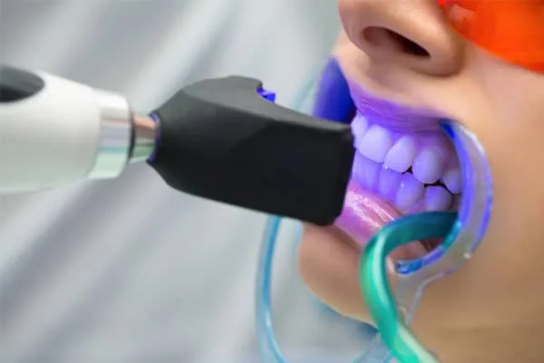 Best Invisalign Treatment in Madurai - Dentes Clinic