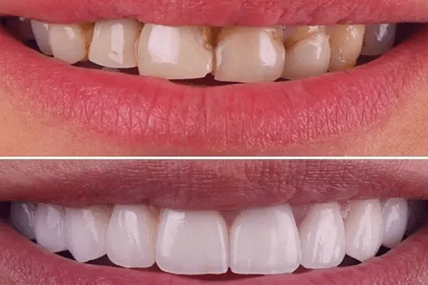Transparent braces for discreet teeth straightening